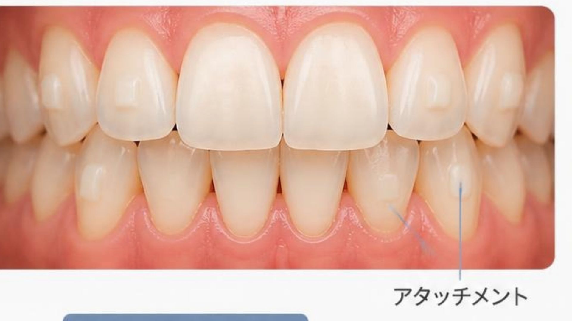 マウスピース矯正でアタッチメントを付けるのはなぜ？役割・種類・注意点を歯科医師が解説